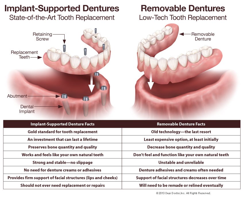 Getting Partial Dentures Louisville KY 40268